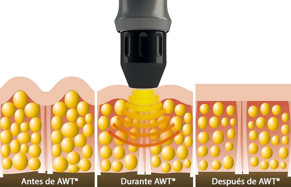 Como actúan las ondas acústicas de AWT®