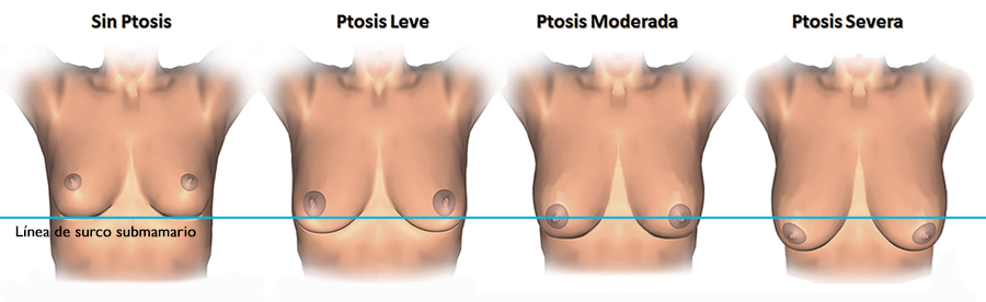 Levantamiento de senos sin implantes: Realce con Lipo y Pexia.